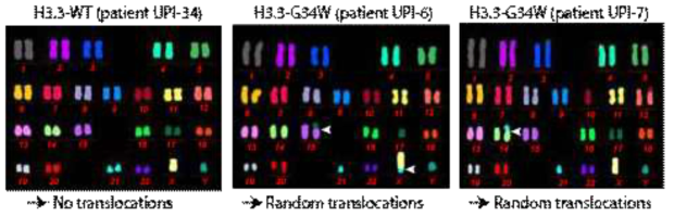 Translocations occur at various location the genome. While we did not observe any alterations in WT patient samples, G34W mutated samples provided a random yet limited pattern of translocations across the genome. This is likely associated with aberrations of telomeric areas and potentially repetitive sequences around the centromeres