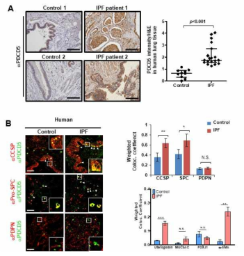 IPF 환자에서 PDCD5의 발현패턴 분석