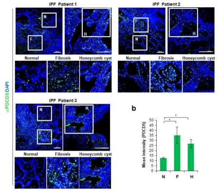 IPF 환자의 정상조직과 honey comb 부위에서의 PDCD5의 발현비교