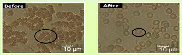 펄스자기장 자극 전후 적혈구의 유착형상 개선