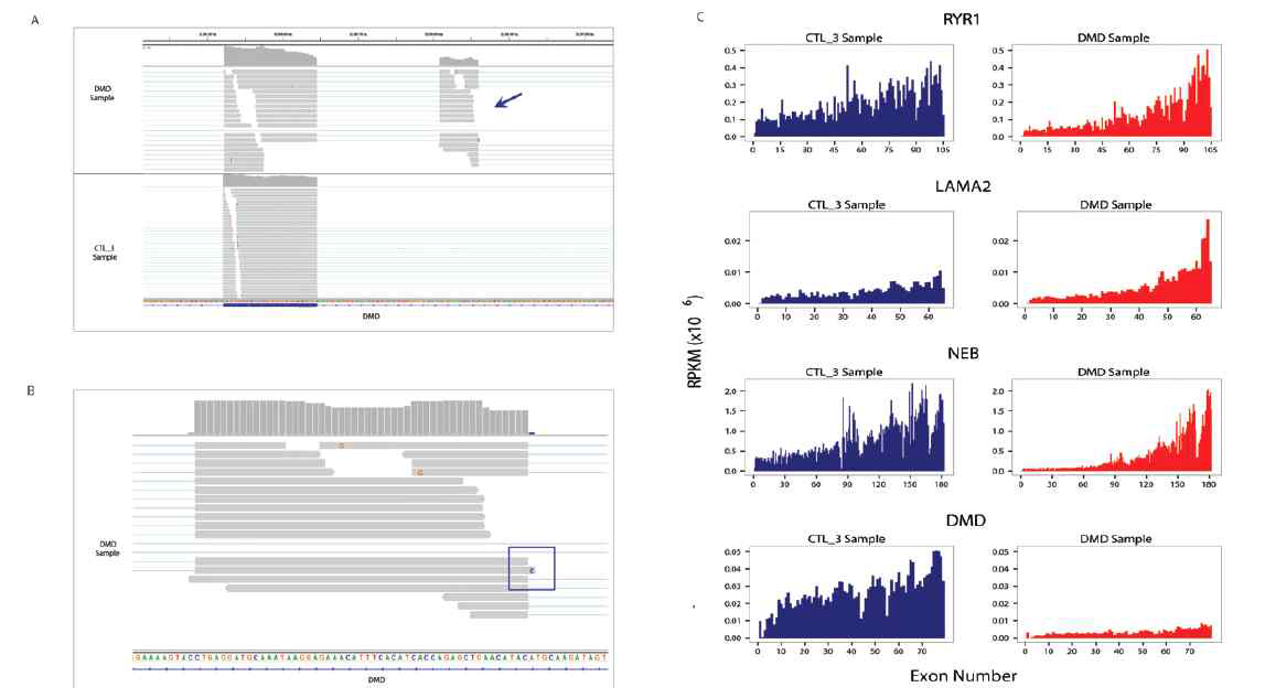 DMD 환자의 변이 발견을 위한 RNA 염기서열분석. (A) DMD 환자에서 control과 비교하였을 때 비정상 전사체를 확인 할 수 있다. (B) 변이 전사체 절편의 확대 이미지 (C) 타질환에서는 큰 전사체를 충분히 커버하고 있으나 DMD 환자군에서는 이 전사체의 발현이 비정상적으로 낮은 것을 확인할 수 있다
