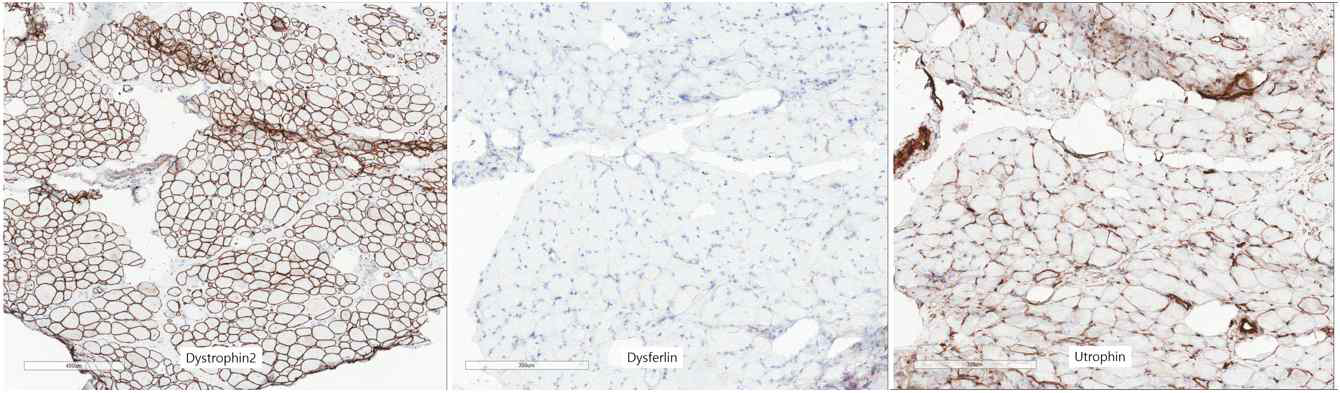 Limb-girdle muscular dystrophy 2B 환자의 면역조직화학염색 사진. dystrophin2와 utrophin stain은 정상이나 dysferlin 염색에서 loss를 보이고 있는 것을 확인