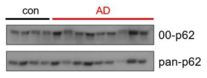 비교적 발현양이 일정한 control에 비해서 알츠하이머병 시료에서는 p62의 00도메인의 노출이 감소되거나 증가되는 등 불규칙임