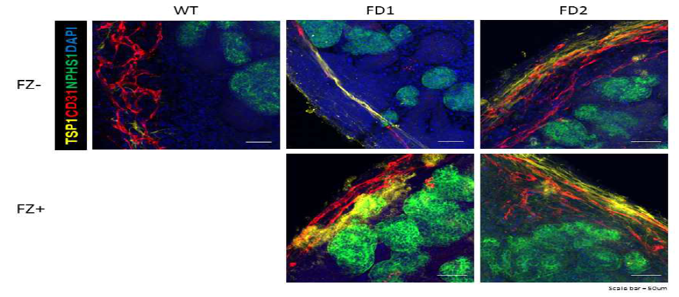 FZ를 처리 후 분화한 파브리병 신장 오가노이드에서 TSP1과 CD31의 발현