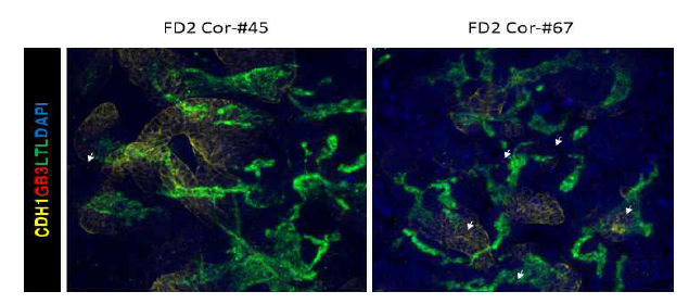 GLA 돌연변이가 정상으로 교정된 FD2 역분화줄기세포주로부터 분화한 신장 오가노이드에서 세뇨관(LTL)과 집합관(CDH1) 마커 및 Gb3 염색