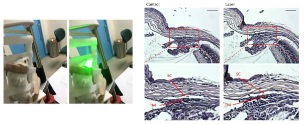 레이저 자극 (laser photocoagulation aimed at the transition zone)