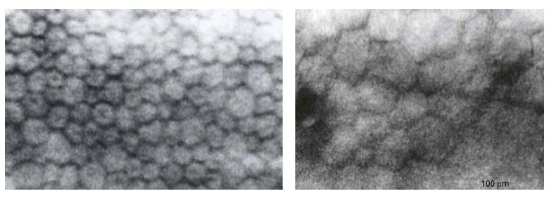 경면현미경 검사 (specular microscopy)에서 정상(좌) 및 수포성 각막병증의 각막내피세포(우)