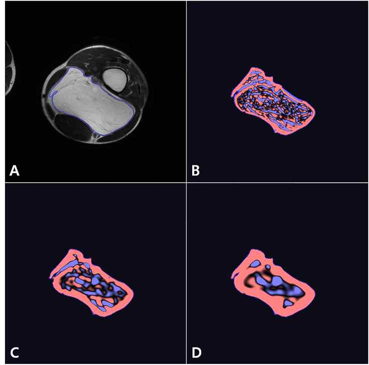 well-differentiated liposarcoma 환자의 texture analysis 및 heterogeneity map. B-SSF2 map, C-SSF4 map, D-SSF6 map