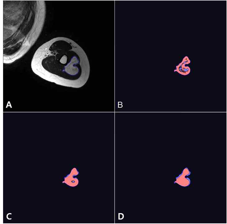 Lipoma 환자의 texture analysis 및 heterogeneity map. B-SSF2 map, C-SSF4 map, D-SSF6 map