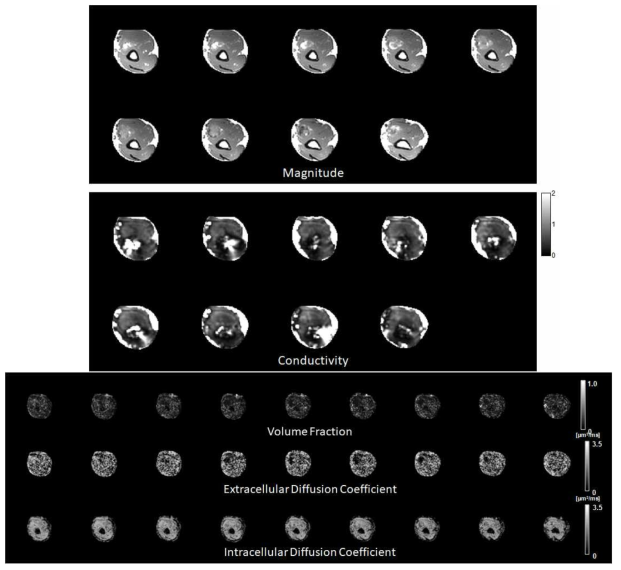 : Elbow mass를 주소로 촬영한 환자의 elbow 촬영 후 획득한 conductivity, volume fraction, extracellular 및 intracellular diffusion 상수 영상