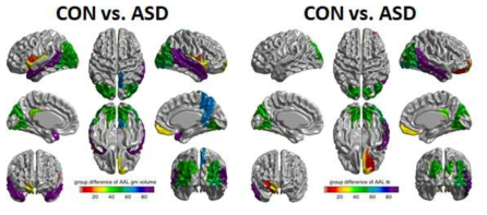 ASD와 HC를 가장 잘 구별하는 뇌부위