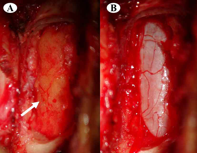 (A) 수술 중 노출된 경막외 지방 조직 (white arroow) (B) 척추 수술 중 자연스럽게 경막외 지방 조직이 제거된 모습 (경막 노출)