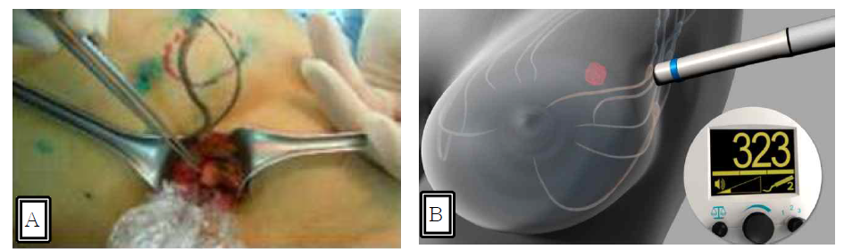 생체시료(A)와 방사성 동위원소(B)를 이용하는 감시림프절 생검술