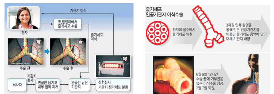 세계최초 기관지 재생술: (좌) 기증자의 탈세포화한 기관지에 환자줄기세포/ (우) 인공기관지에 환자줄기세포 파종 후 이식 사례