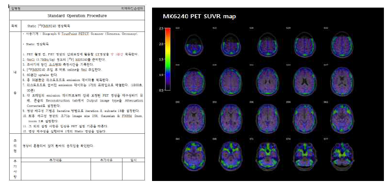 18F-MK6240 PET SOP 확립(왼쪽) 및 정상인의 SUVR map 분석(오른쪽)