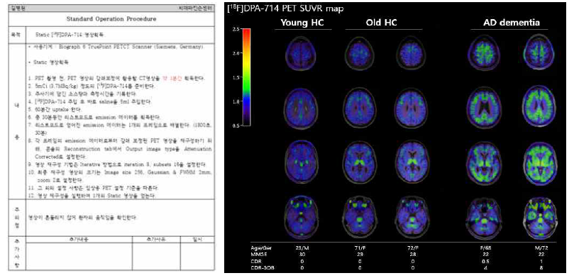 18F-DPA714 PET SOP 확립(왼쪽) 및 젊은 정상인 나이든 정상인과 알츠하이머병 환자의 18F-DPA714 PET SUVR map 영상(오른쪽)