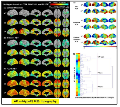 알츠하이머병의 아형에 따른 topographical map