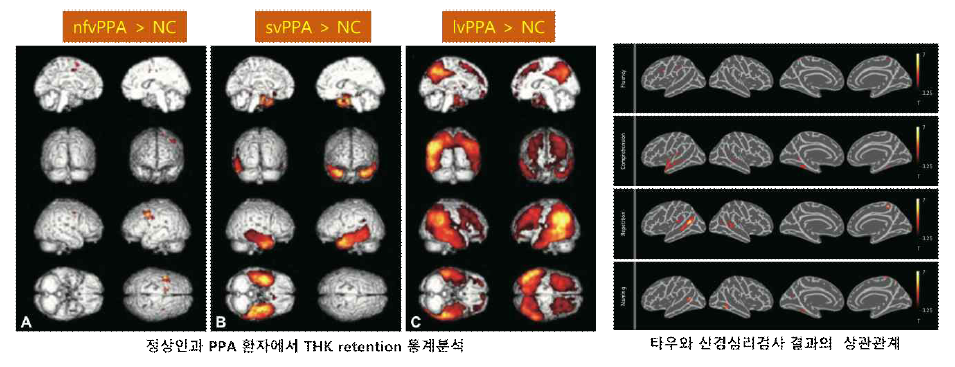 PPA 환자에 대한 타우단백질 침착비교 및 신경심리검사 결과와의 상관관계