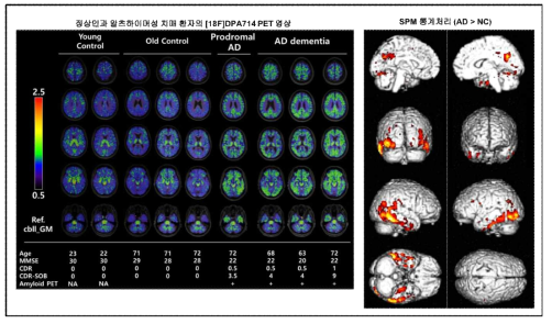 정상인 및 치매환자에 대한 뇌신경염즘 PET 영상 및 통계처리
