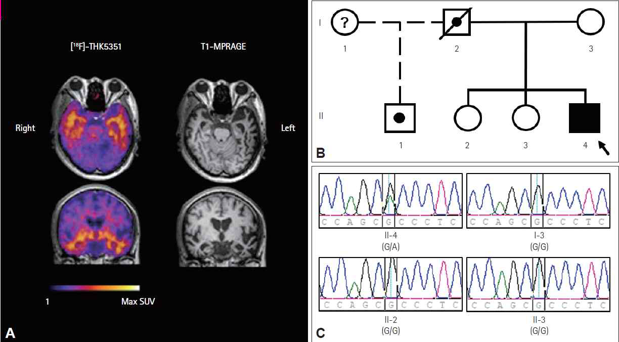 A: svPPA 환자의 [18F]THK5351 영상과 T1-MPRAGE 영상, B: svPPA 환자의 가계도, C: svPPA 환자 및 환자 가족들의 Sanger sequencing 결과
