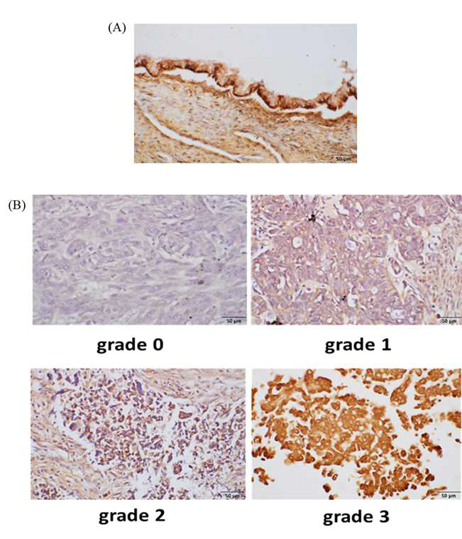 상피성 난소암과 양성 난소종양에서 사이토카인 신호전달 억제제 4 (SOCS4, Suppressor of Cytokine Signaling 4) 단백질에 대한 면역화학염색 (immunohistochemical staining) 결과 (A) 양성 난소종양, (B) 상피성 난소암