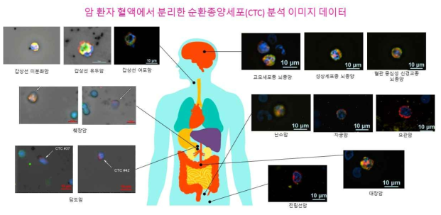 다양한 암종에 대해 환자 혈액으로부터 검출, 확인한 순환종양세포