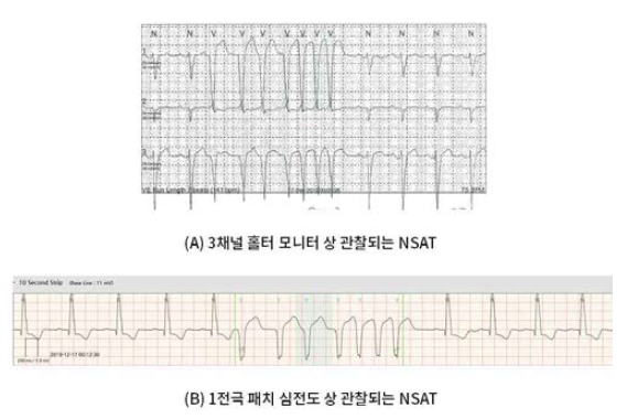 24시간 홀터에서 표현되었던 것이 1전극 패치 심전도상에서 잘 구현됨을 확인