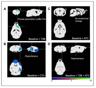 항암제 치료 후 MRI 영상을 통한 회색질의 밀도 분석을 통한 뇌 손상 독성 평가