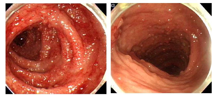 R그룹의 분변미생물이식술 전·후의 내시경 사진