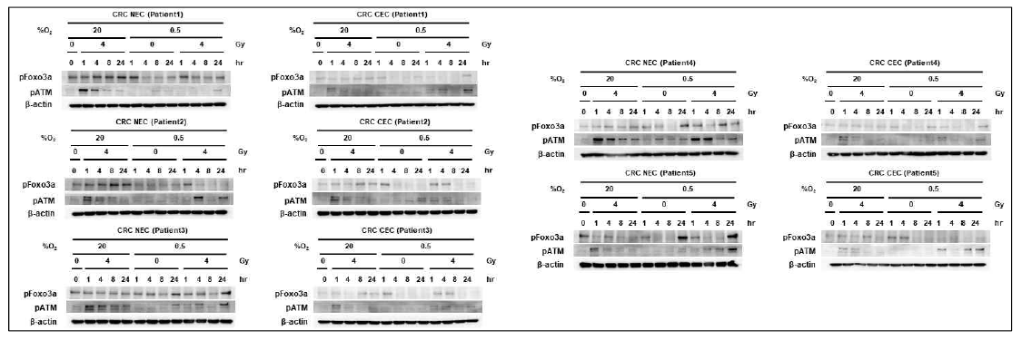 Expression of proteins related to radiosensitivity of cells in irradiated normal and cancer endothelial cells isolated from human colorectal cancer tissues under normoxia and hypoxia