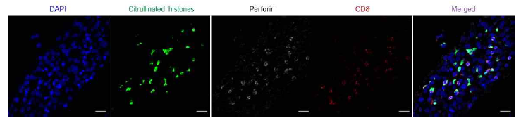 류마티스 관절염 관절 조직 내 citrullinated 단백과 perforin+ CD8 T세포의 존재 확인