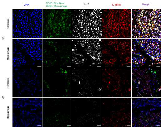 류마티스 관절염 관절 조직 내 IL-15, IL-15Rα 발현 관찰 RA; rheumatoid arthritis OA; osteoarthritis