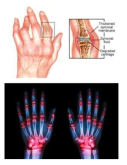 류마티스 관절염의 개요