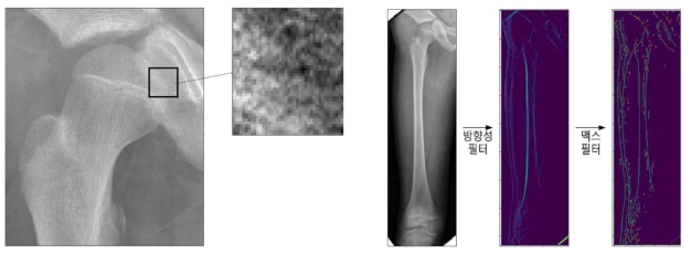 (좌)방사선 영상에서 윤곽선 추출이 어려운 원인분석. 윤곽선 부분의 모호성. (우)방사선 영상을 세로방향 필터를 사용해 변환한 방사선 영상