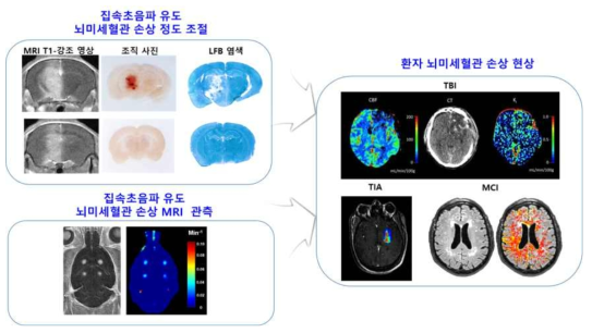 집속초음파를 이용한 뇌미세혈관 손상 모델 – 환자 뇌미세혈관 손상 유사성