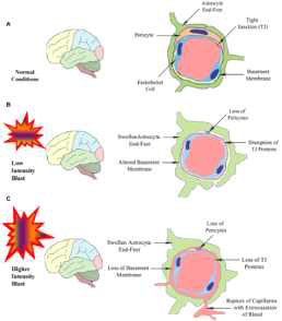 (A) 정상인 (B) mild TBI (C) severe TBI 환자 상태에 따른 뇌미세혈관손상정도