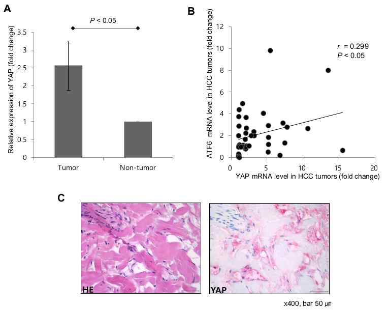 Human HCC 조직에서 up-regulated YAP-1 발현과 ATF-6 발현과의 양의 상관관계