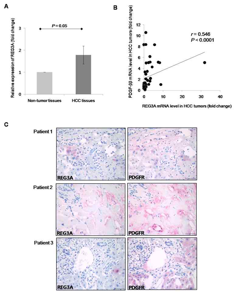 간세포암 환자의 종양 조직에서의 REG3A 발현 및 PDGF-ββ, PDGF-receptor 발현양상