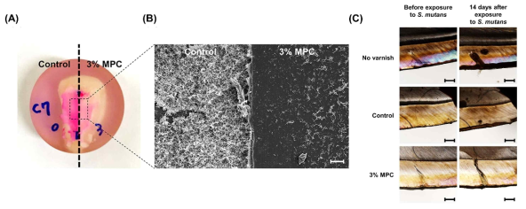 3% MPC를 함유한 광경화성 불소 바니쉬의 탈회 예방 효과. (A) 기존의 광경화성 불소 바니쉬(control)와 비교하였을 때 3% MPC 군의 치면 착색 정도가 옅고, (B) 부착된 S. mutans의 수가 유의하게 적었으며, (C) 탈회 깊이(demineralization depth) 또한 control에 비해 약 50% 감소함