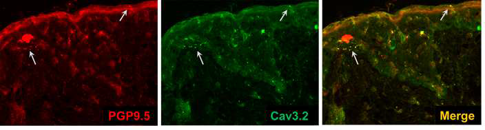 T-type calcium channels, Cav3.2 subtype is co-localized with nerve marker, PGP9.5 in normal human skin (Immunofluorescence stain for Cav3.2 and PGP9.5)