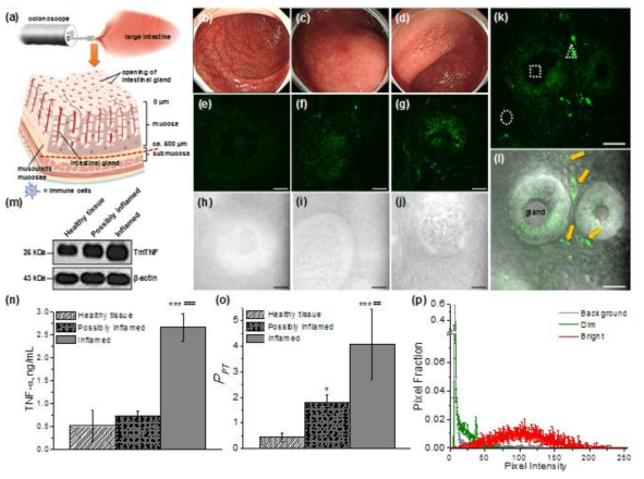 a) A schematic illustration of the process of large-intestine biopsy using a colonoscope (upper panel) and a biopsy tissue cut to the dashed red line (lower panel). b–d) Endoscopic images of a healthy, possibly inflamed, and inflamed colon. e–l) TPM and bright-field images of healthy (e,h), possibly inflamed (f,i), and inflamed colon tissues (g,j) labeled with Pyr1-infliximab (7.0 μM). Images were captured at a depth of 30–70 μm by recording TPEF at 380–660 nm upon excitation at 750 nm and 100´ magnification. k,l) An enlarged TPM image (k) and a merged (with bright field) image of inflamed tissues (l). The white dotted square, circle, and triangle in panel (k) indicate a background, dim spot, and bright spot in the TPM image, respectively. The golden arrows in panel (l) point to individual cells containing the endosomal PT complexes. m) A western blot result revealing the expression of TmTNF (26 kDa) and β-actin (43 kDa) in healthy, possibly inflamed, and inflamed tissues. n) TNF-α concentration in healthy, possibly inflamed, and inflamed tissues, as measured by ELISA assay. *** and ### indicate statistically significant differences between healthy and inflamed (p < 0.001) and between possibly inflamed and inflamed tissues (p < 0.001), respectively. o) The relative proportion of the endosomal PT complexes (PPT) in healthy, possibly inflamed, and inflamed tissues labeled with Pyr1-infliximab (7.0μM), as calculated from 51, 43, and 59 TPM images of the healthy (four samples), possibly inflamed (three samples), and inflamed (five samples) tissues, respectively. *,***,and## point to statistically significant differences between healthy and possibly inflamed (p < 0.1), between healthy and inflamed (p < 0.001), and between possibly inflamed and inflamed tissues (p < 0.01), respectively. p) Plots of the pixel fraction vs. pixel intensity for the background, dim, and bright regions indicated in panel (k). Scale bars: (e–l) 20 μm