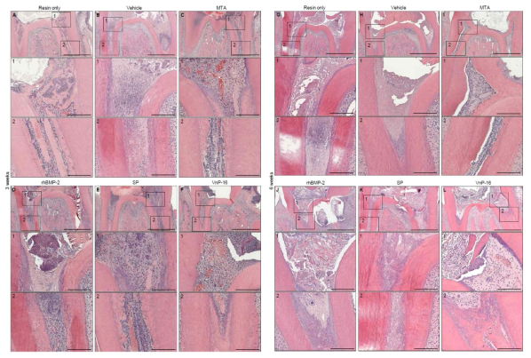 Histological analysis of dentin regenerated by VnP-16 at the orifice of root canal after 3 weeks and 6 weeks. After removing the enamel and dentin from the mandibular first molars of rats, pulpotomy was performed. (A, C, G, I) The removal sites of the coronal pulp of the mandibular first molars of rats were filled with resin only (A, G) and mineral trioxide aggregate (MTA) only (C, I). (B, D-F, H, J-L) The other removal sites of the coronal pulp of the mandibular first molars were capped with vehicle (5% DMSO, B and H)-, rhBMP-2 (31.4 ng/scaffold, D and J)-, SP (15.7 μg/scaffold, E and K)-, or VnP-16 (15.7 μg/scaffold, F and L)-treated collagen sponges, filled with resin, and bred for 3 weeks (A-F) or 6 weeks (G-L). Rats were euthanized by inhaling carbon dioxide, and mandibular specimens containing the first molars were obtained. After demineralizing the mandibular specimens, H Scale bars of middle and lower panel, 200 μm