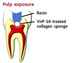 Schematic diagram for evaluating the effect of VnP-16 on reparative dentin formation in a rat pulp exposure model