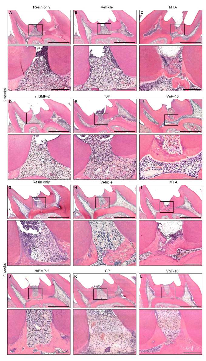 Histological analysis of regenerated dentin by VnP-16 at the sites of pulp exposure at 2 and 4 weeks after wounding. After removing the enamel and dentin from the mandibular first molars of rats, the pulps were exposed with a round bur. (A, C, G, I) Pulp exposed areas of the mandibular first molars of rats were filled with resin only (A, G) and mineral trioxide aggregate (MTA) only (C, I). (B, D-F, H, J-L) The other pulp exposed portions of the mandibular first molars were capped with vehicle (5% DMSO, B and H)-, rhBMP-2 (31.4 ng/scaffold, D and J)-, SP (15.7 μg/scaffold, E and K)-, or VnP-16 (15.7 μg/scaffold, F and L)-treated collagen sponges, filled with resin, and bred for 2 weeks (A-F) or 4 weeks (G-L). Rats were euthanized by inhaling carbon dioxide, and mandibular specimens containing the first molars were obtained. After demineralizing the mandibular specimens, H Scale bars of middle and lower panel, 200 μm