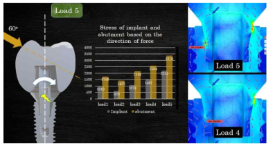 임플란트에서 힘의 방향이 임플란트 중심에서 많이 벗어날수록 임플란트에서 더욱 강한 스트레스가 발생함