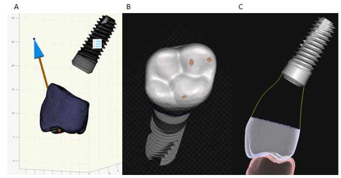 임플란트와 디자인된 수복물 및 대합치의 삼차원적 관계. (A) 는 교합점의 평균 벡터를 자동으로 계산하여 시각화 시키는 영상. (B, C) 임플란트 수복물의 3차원 디자인 및 교합점 위치 확인