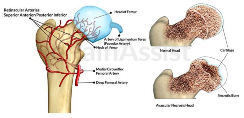 대퇴골두 무혈성괴사 (Avascular necrosis, AVN)