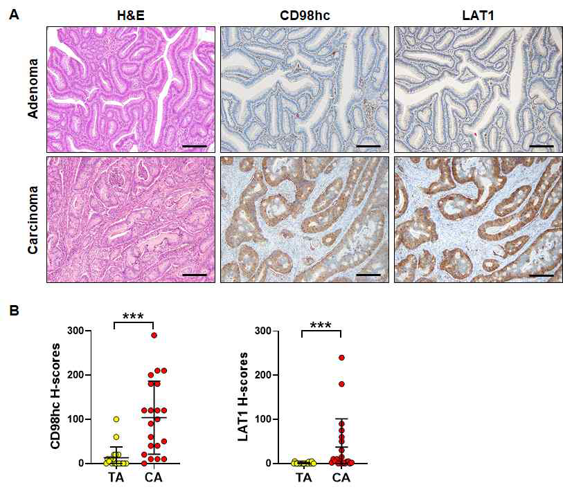 Expression profile of CD98 heavy chain (CD98hc) and LAT1 in colorectal precancerous lesions. Representative images of CD98hc and LAT1 expression in normal colonic mucosa (N, n = 9) (A), hyperplastic polyp (HP, n = 8) (B), sessile serrated adenoma (SSA, n =23) (C), traditional serrated adenoma (TSA, n = 13) (D), tubular adenoma with low grade dysplasia (TALG, n = 24) (E), and tubular adenoma with high grade dysplasia (TAHG, n = 21) (F) . Histo-scores of CD98hc (G) and LAT1 (H) in each lesion. Data are presented as the mean ± SEM. SEM: standard error of the mean. ns, not significant. ***P < 0.001