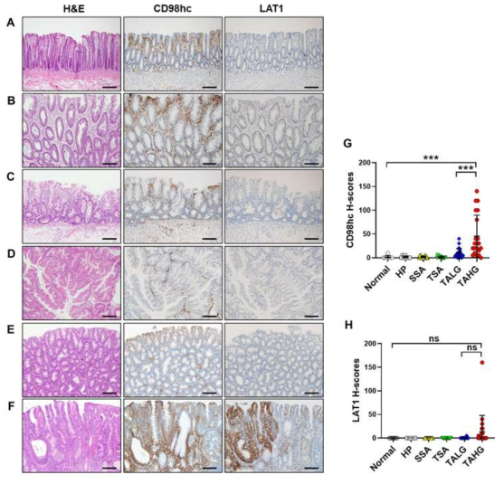 Decline of CD98 heavy chain (CD98hc) expression during lymph node metastasis (n = 68). (A) Representative images of CD98hc and LAT1 expression in a colorectal cancer with regional lymph node metastasis, in which CD98hc expression declined when cancer cells metastasized to lymph nodes. . (B) Histo-scores of CD98hc decreased in lymph node metastasis while no alteration was observed in LAT1 expression over metastasis. Data are presented as the mean ± SEM. SEM: standard error of the mean. ns, not significant. ***P < 0.001