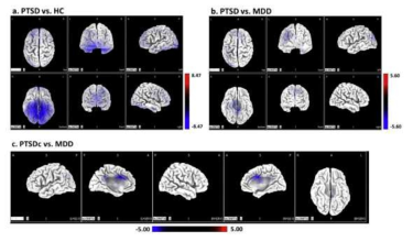 우울증, PTSD 및 정상인의 source activity 비교